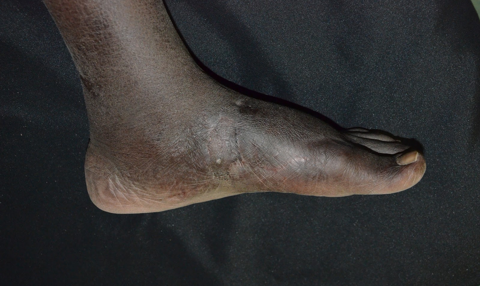 NON HEALING WOUND RIGHT FOOT SKIN GRAFTING INFECTIONS, DIABETIC