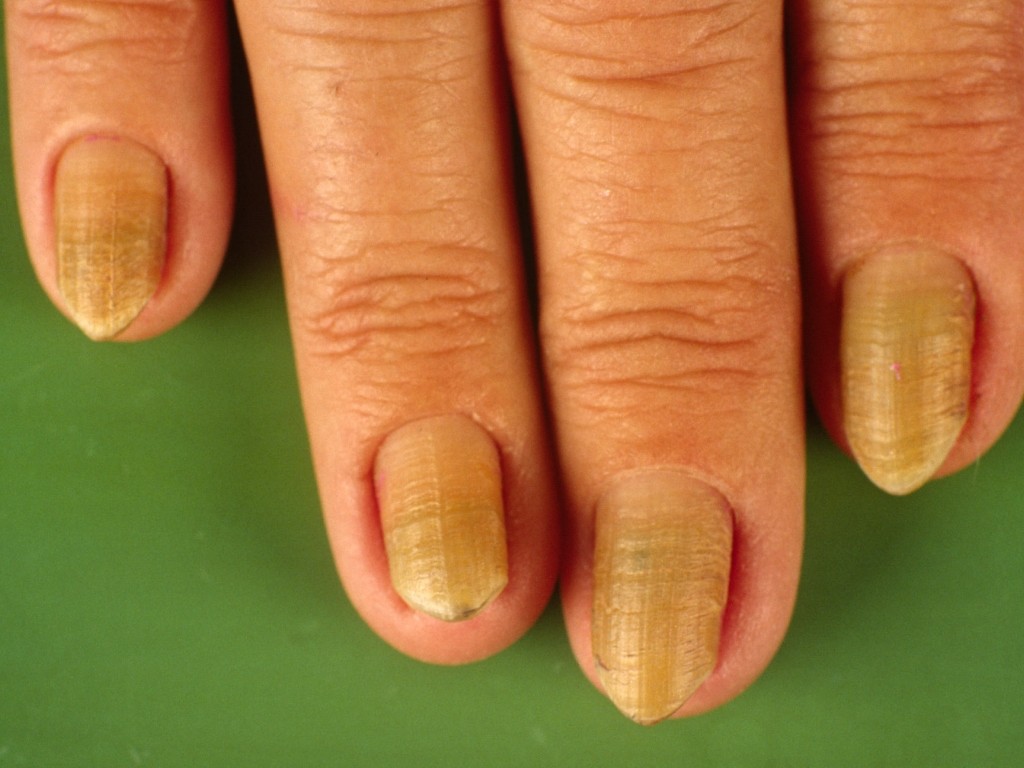 2. Yellow Nail Syndrome - wide 7