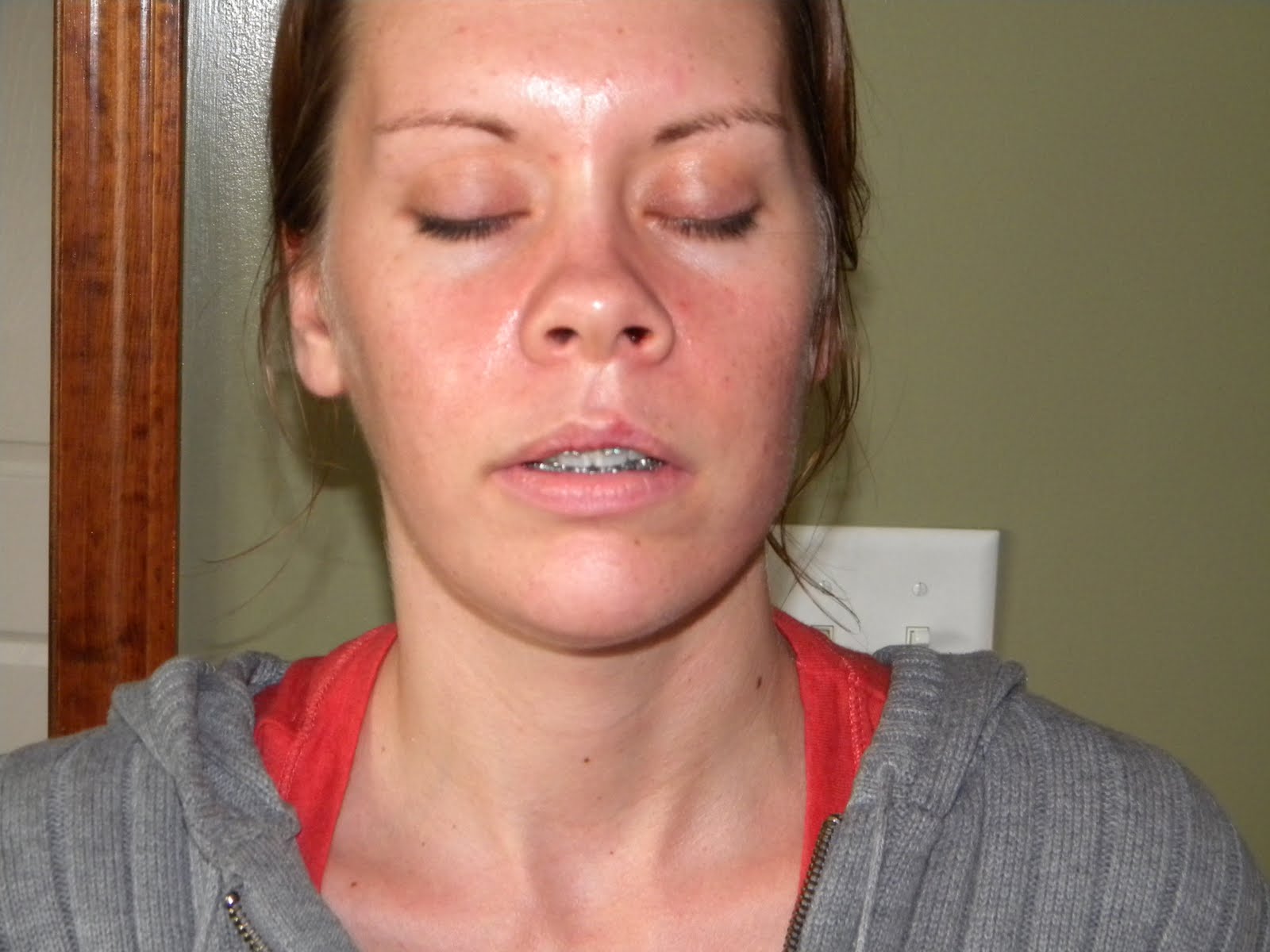 Jaw Surgery
