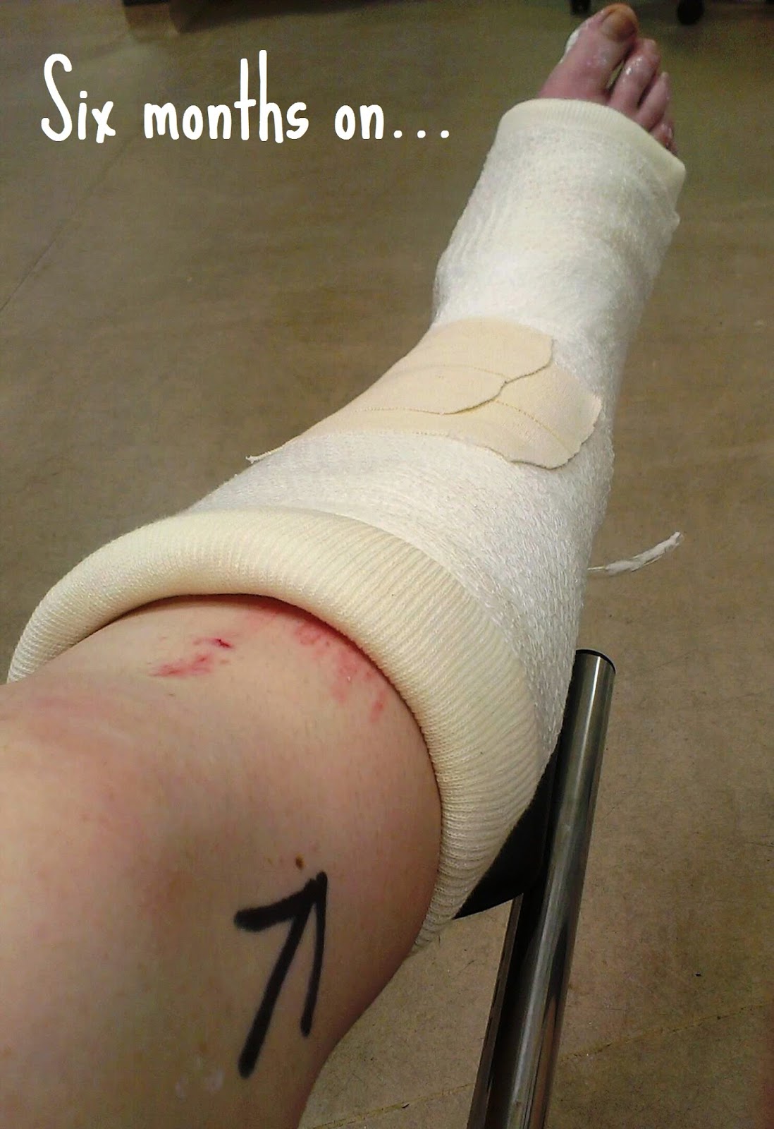 Recovering from a Trimalleolar Fracture - six months on