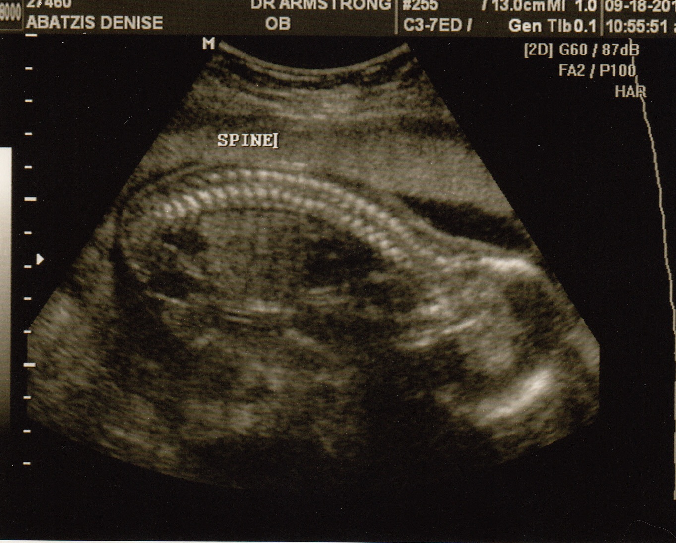 Life in the Abatzis Household: Lentil's 20 Week Ultrasound ...