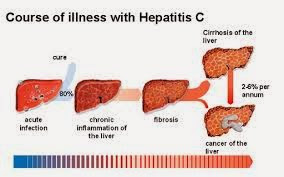 http://pusatobatherbal19.blogspot.com/2015/05/cara-mengobati-penyakit-hepatitis-c.html
