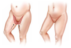 Plastic surgery after massive weight loss cheap body lift abroad