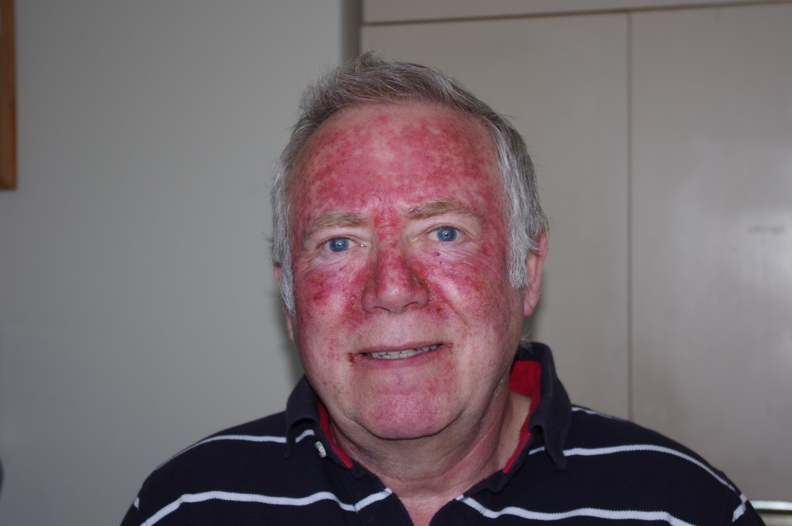 Alan's Efudix/Efudex Experience