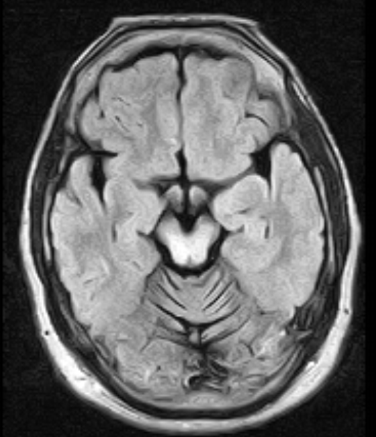 wernicke encephalopathy