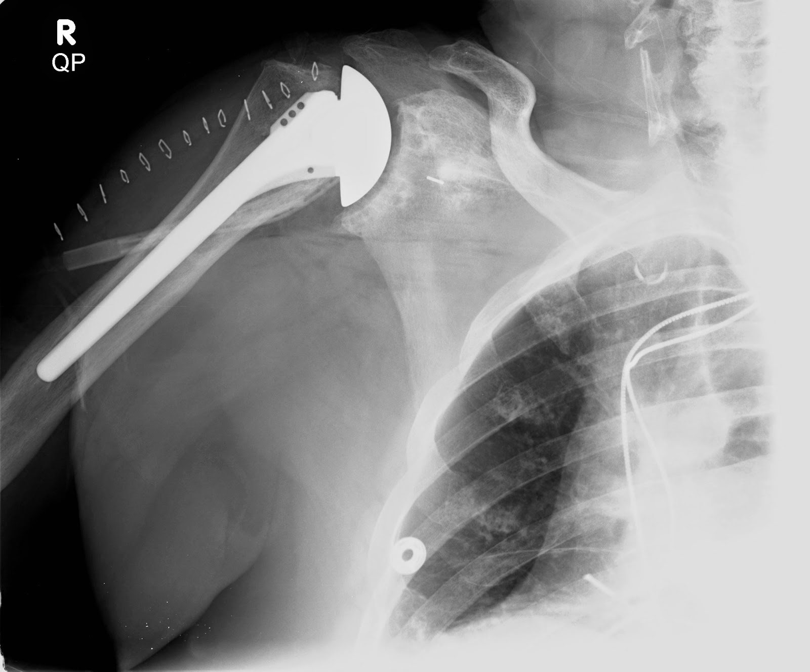 Shoulder and Elbow Surgery The radiographic analysis of a total