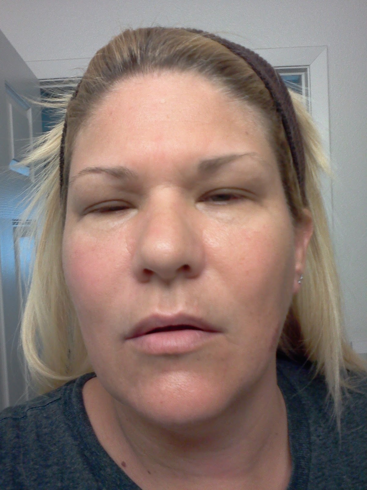 Life with Lupus Swelling/Edema and visual issues