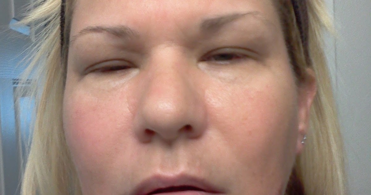 Life with Lupus Swelling/Edema and visual issues