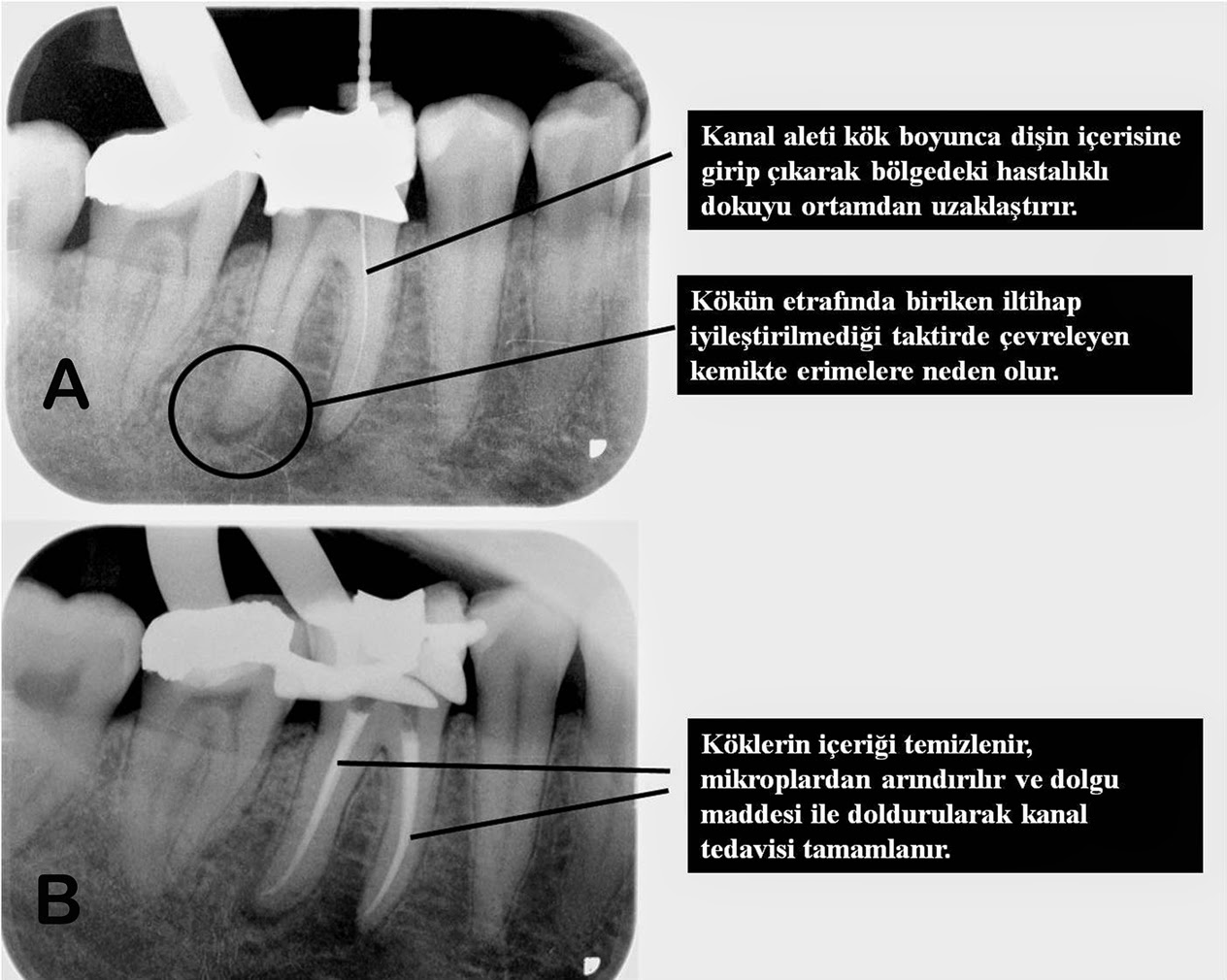 Neşe Tuana Kanal Tedavisi Sonrası Yüzde Şişlik