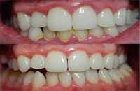 gingivitis halitosis gingivitis halitosis