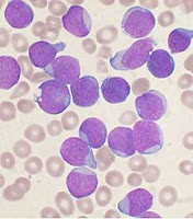 Globules blancs atteints de leucémie aigüe lymphoblastique