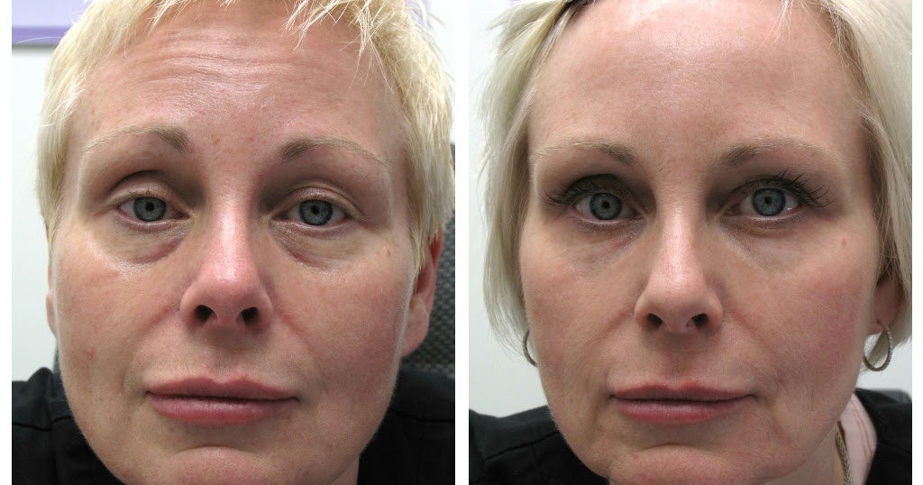 Guelph Medical Laser Before & Afters