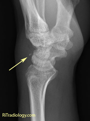 Fracture Triquetrum