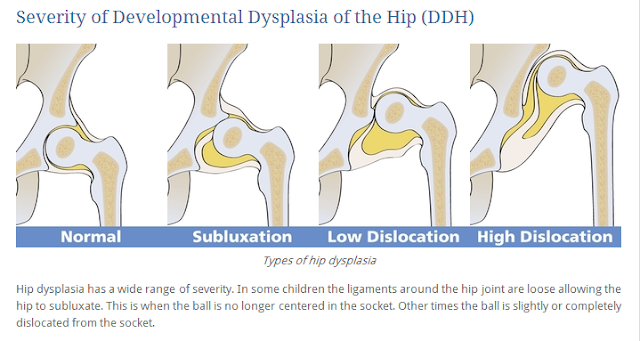 Help Me Grow Hip Healthy Swaddling Developmental