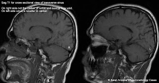 sinus transverse hypoplastic abnormal signal mri normal sag t2 t1 flair sigmoid hypoplasia flow void frcr anvekar balaji dr signals