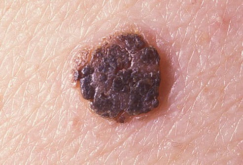 Picture of Seborrheic Keratosis