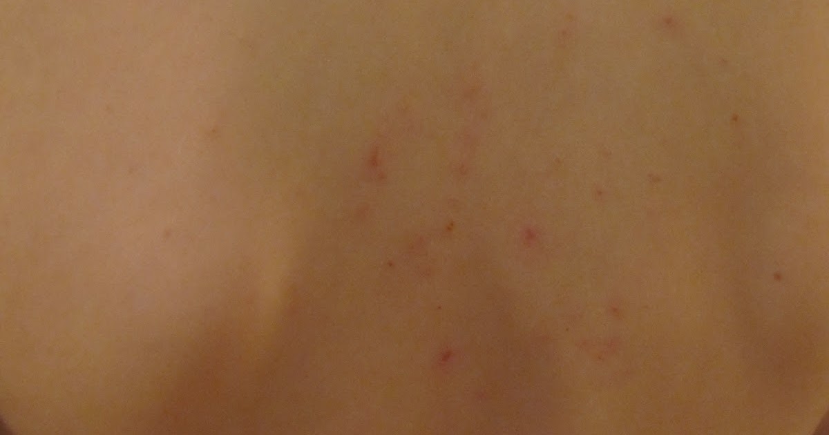 My life...living loving & blogging about it! BED BUGS at The Great