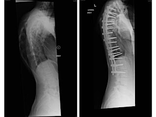 My side xrays before and after scoliosis surgery