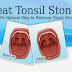 How to Get Rid of White Spots on Tonsils | Top Ways to Remove Tonsil Stones