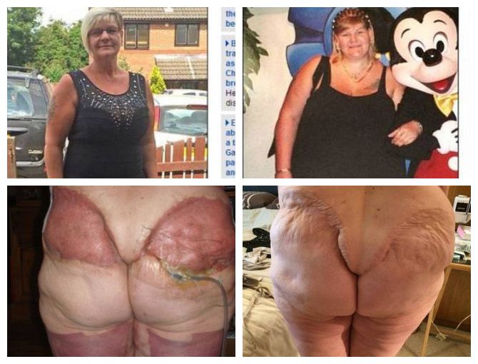 Após perder 70 kg, mulher passa por cirurgia para retirar excesso de pele e fica deformada