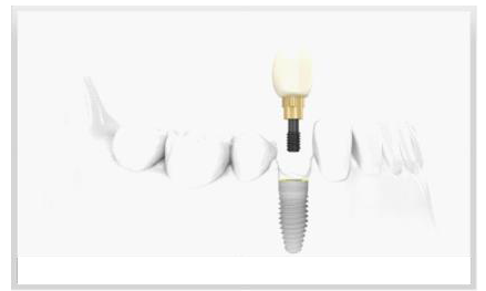 Dental Implants Silver Spring