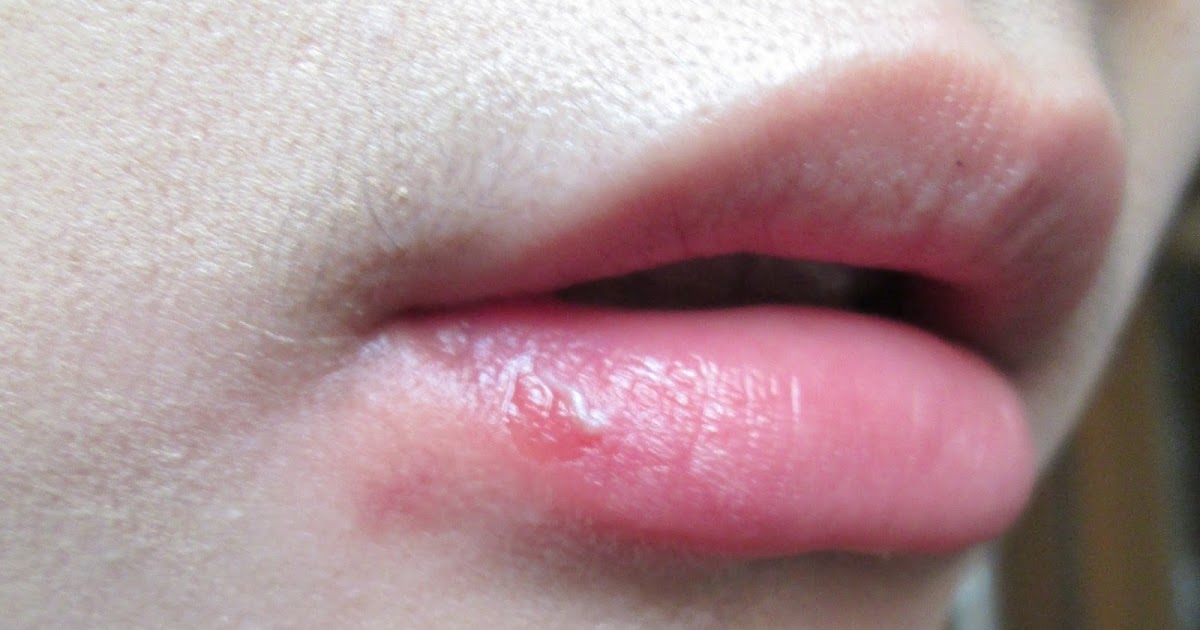 Joy's Commentary Ouch! Burned Lip!