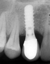 Xray showing Dental Implants