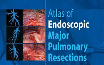 Atlas Phẫu thuật Nội soi cắt thùy phổi
