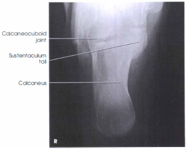 normal calcaneal axial view