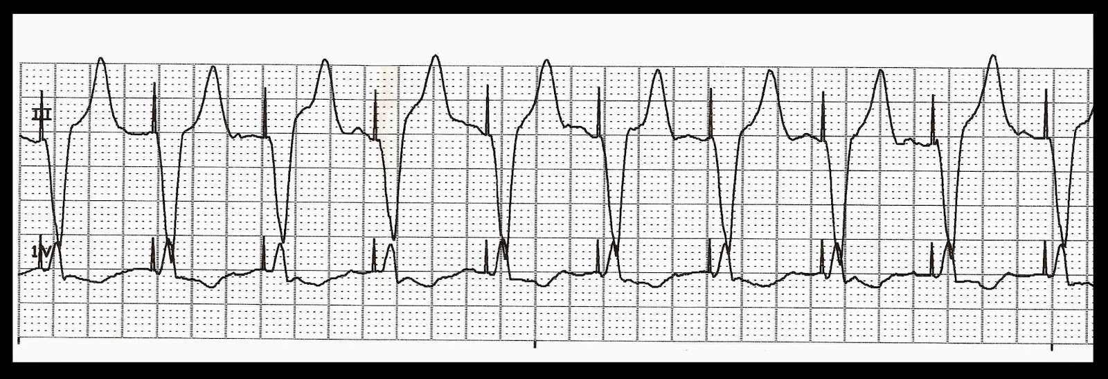 ventricular paced rhythm with failure to capture ventricular paced rhythm with failure to capture