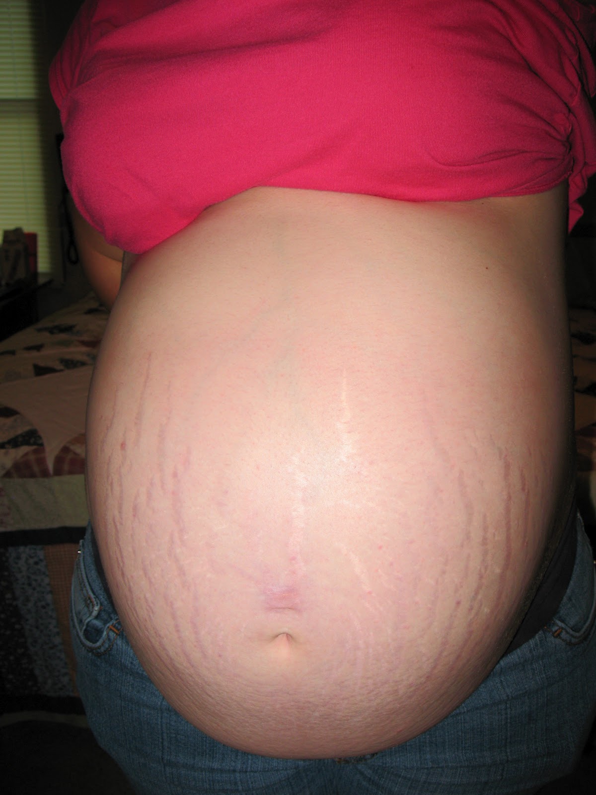 Skin Stretch Marks