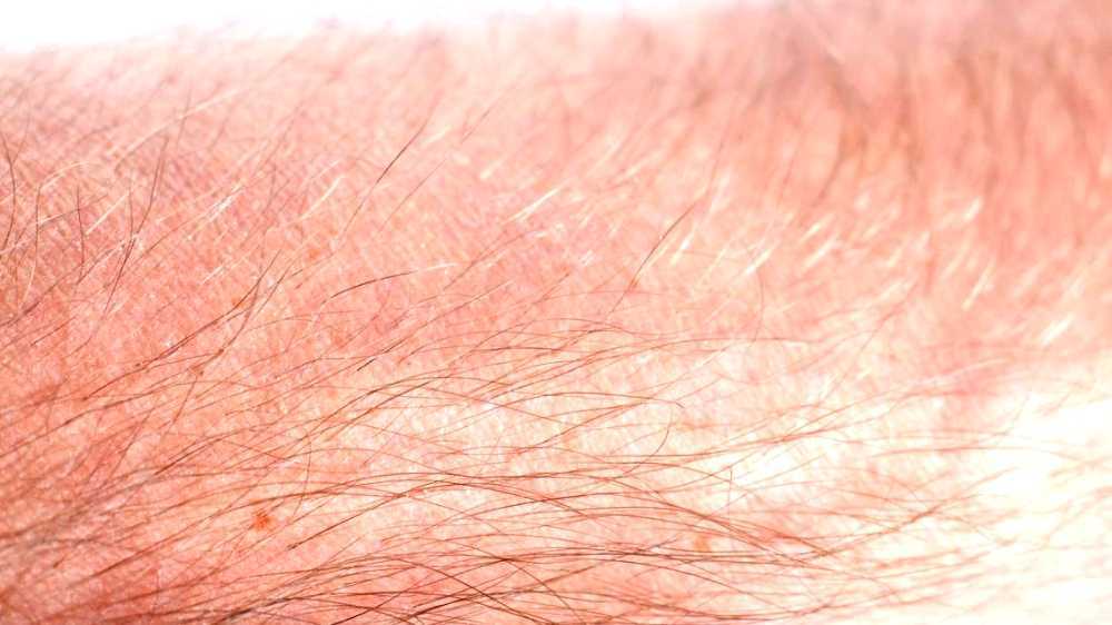 Vellus Hair