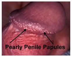 Pearly papules pink Pearly Penile