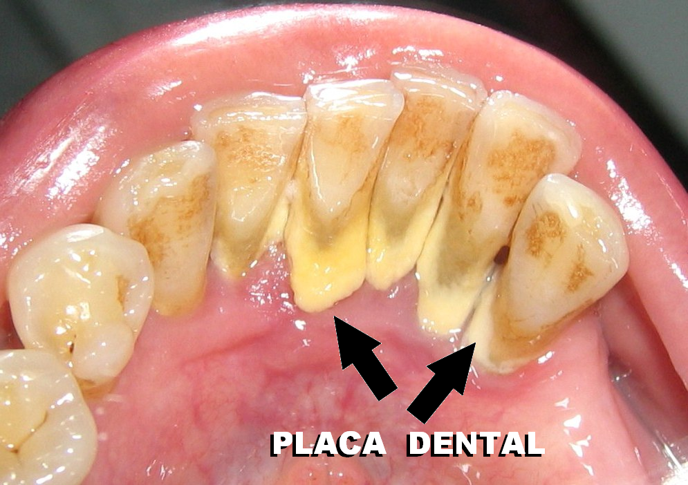 ENFERMERIX LAS BACTERIAS DE LA PLACA DENTAL PUEDEN PROVOCAR COÁGULOS