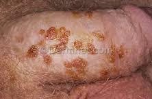 pimples on private parts female home remedies pimples on private parts female home remedies