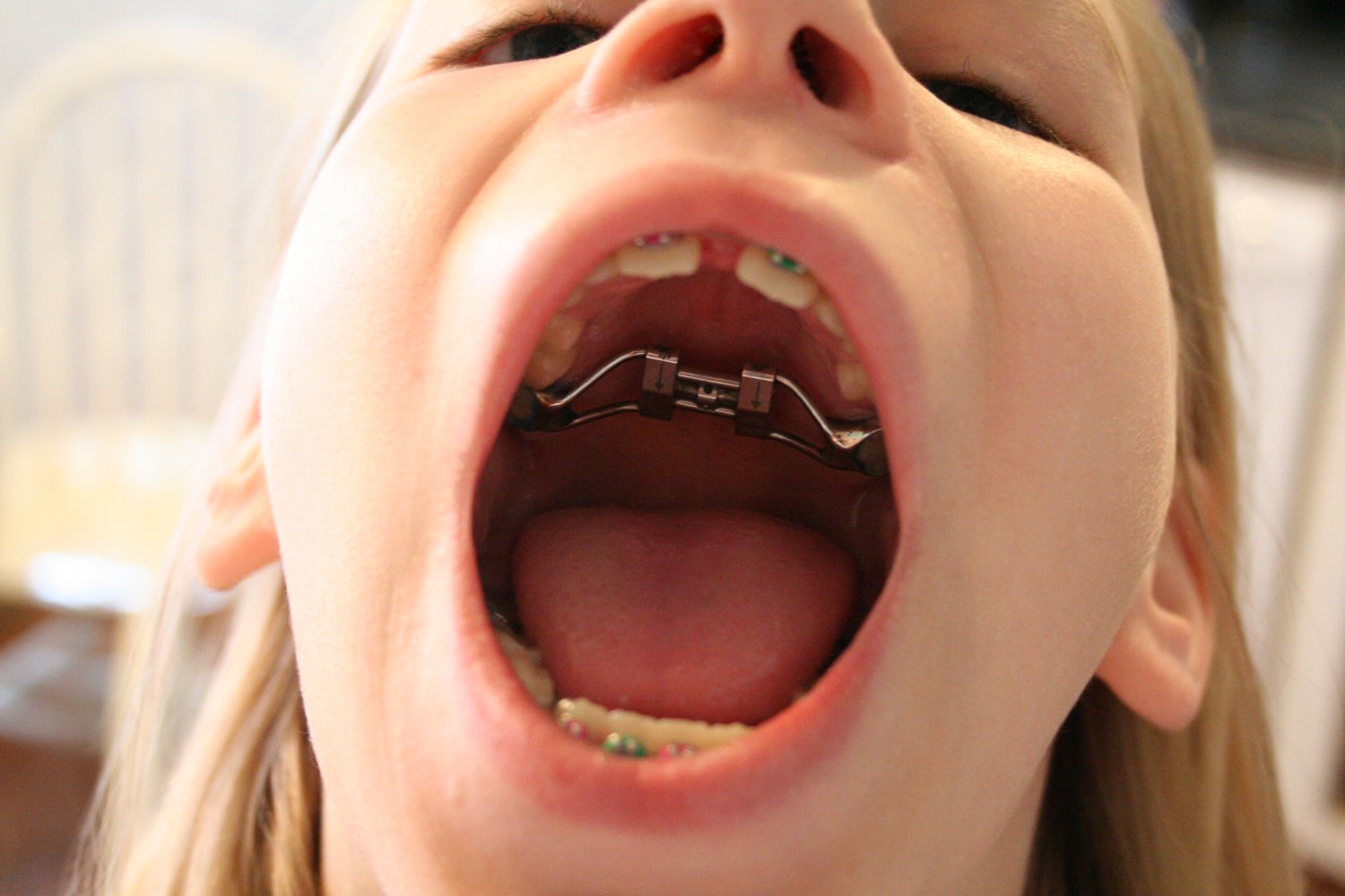 Teen Girl Mouth