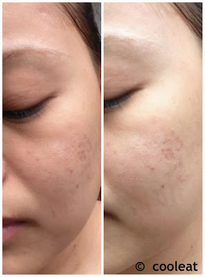 Kojie San Skin Lightening Soap Before and After