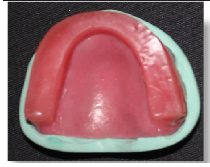 Step by step Guide for Understanding the Prosthodontics Complete