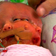 Two Head In One Body: Australian woman Gives Birth To Conjoined Twin Girls [Photos]