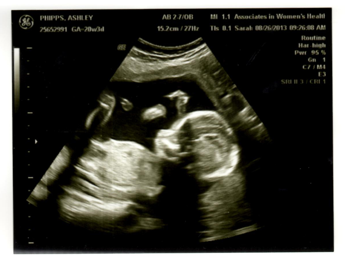 20 Week Doctor Appointment {Our Trisomy 18 Baby)