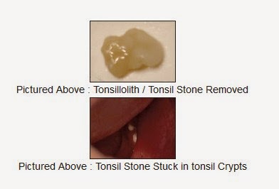 Tonsil Stones Picture Tonsil Stones Picture