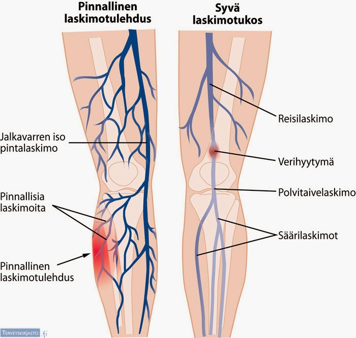 Bakerin kysta väsymys