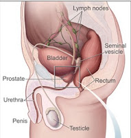 Kanker+Prostat2.jpg