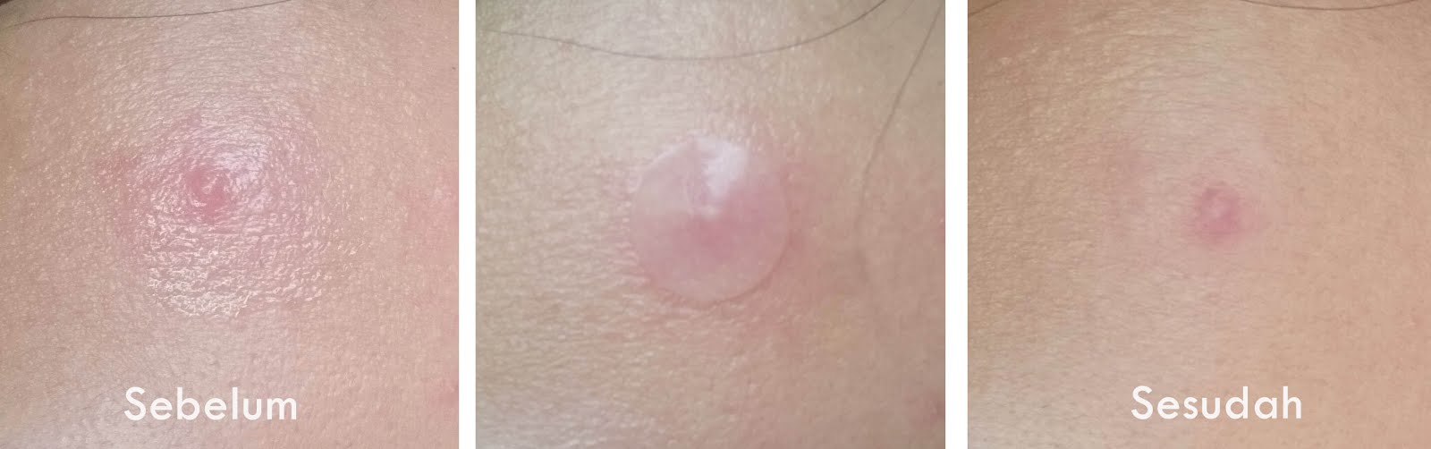 Image result for ACNE PIMPLE MASTER PATCH review