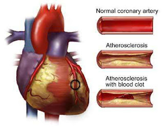 Penyebab Gejala Pencegahan Penyakit Jantung Koroner