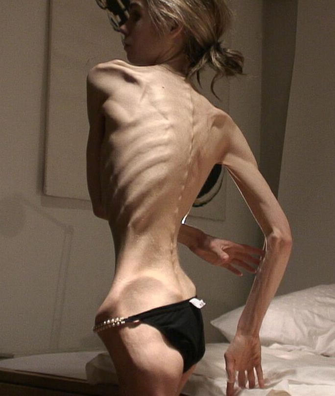 anorexia_02.jpg.