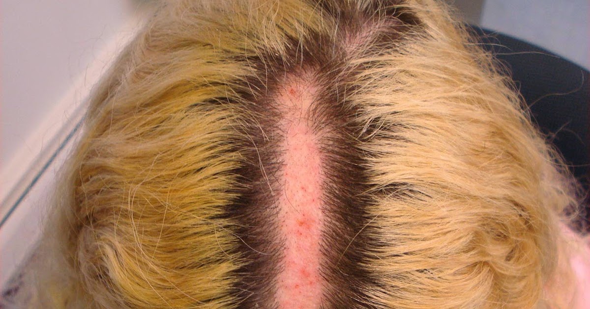VIRTUAL GRAND ROUNDS IN DERMATOLOGY 2.0: Scalp Burn Post ...