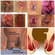 Ramuan Alami Obat Ambeien Ramuan Alami Obat Ambeien
