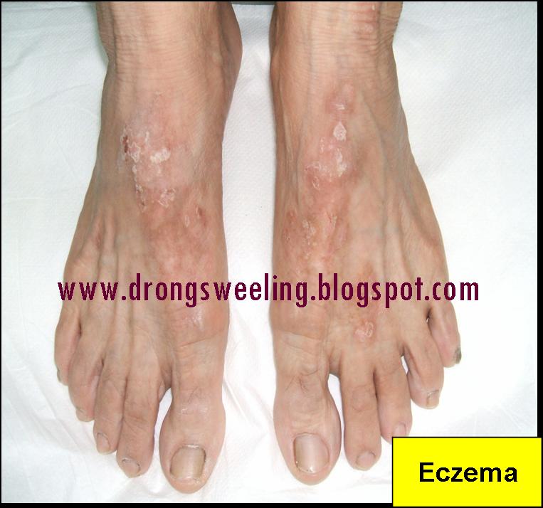 TCM News TCM Eczema Treatment for Eczema, Psoriasis, Best TCM Doctor