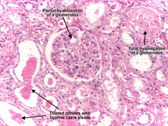 Cell Injury Pathology